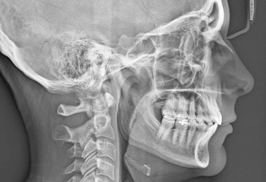 High resolution X Rays with Computed Radiography