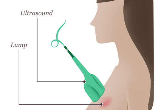 USG of Breast and Axilla (Armpits)