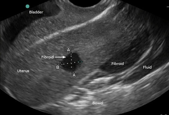 Transvaginal Sonography for Female Pelvic Pathology