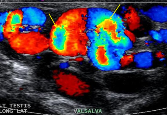 USG / Colour Doppler of Scrotum / Testis